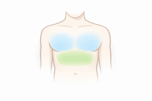 Chest Burning Without Exercise: Reflux or Heart Problem?