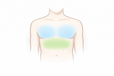 Chest Burning Without Exercise: Reflux or Heart Problem?