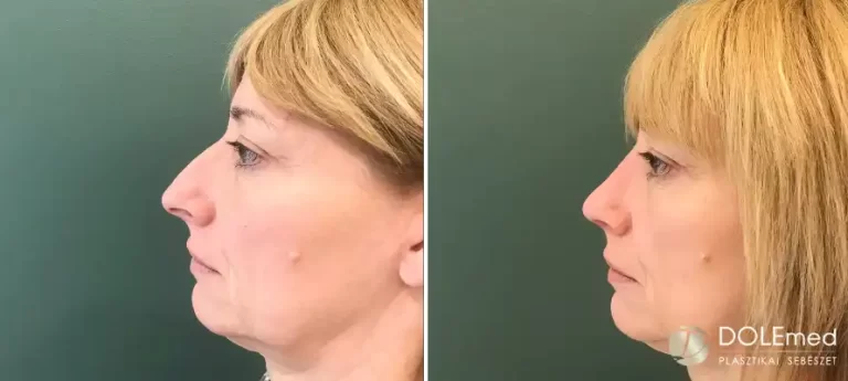 nose surgery before after 01 768x345