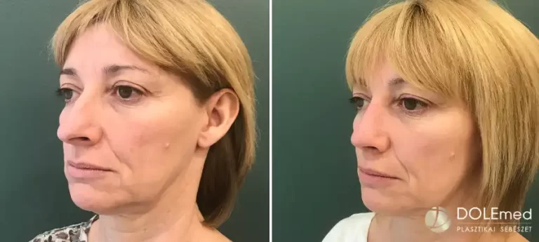 nose surgery before after 02 768x345