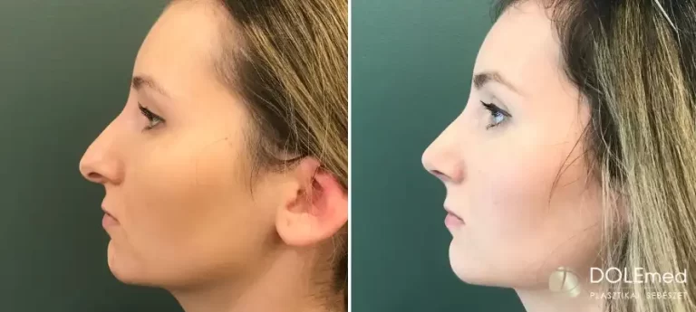 nose surgery before after 03 768x345