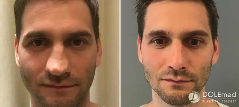 nose surgery before after 04 768x345
