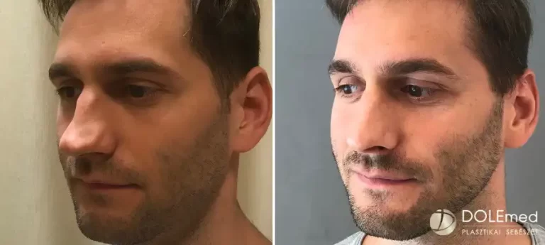 nose surgery before after 05 768x345