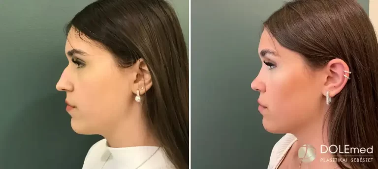 nose surgery before after 06 768x345